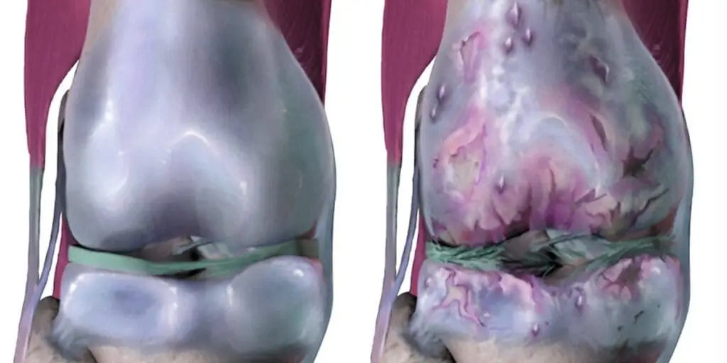 New study shows psteoarthritis may be treatable and reversible