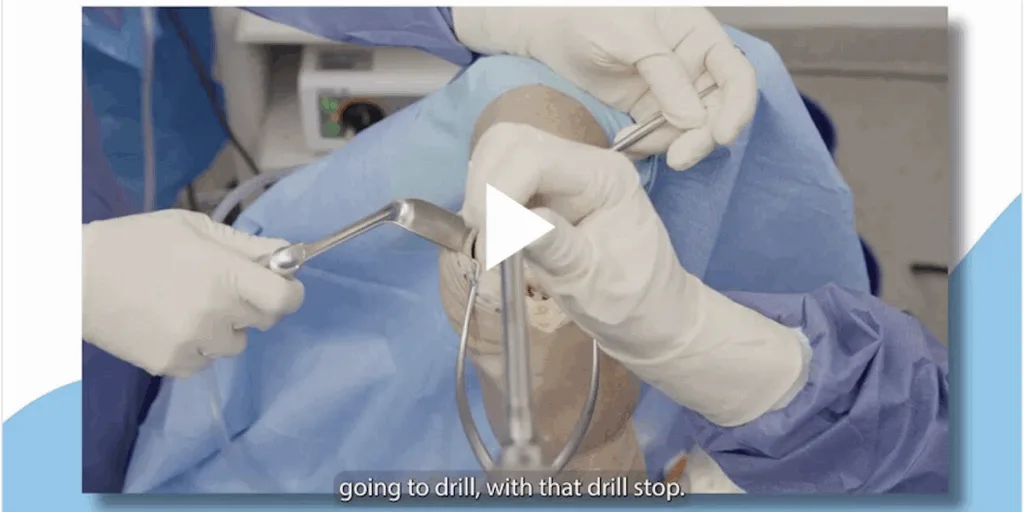 Dr. Sabrina Strickland discusses using CARTIHEAL AGILI-C to treat trochlea lesions.