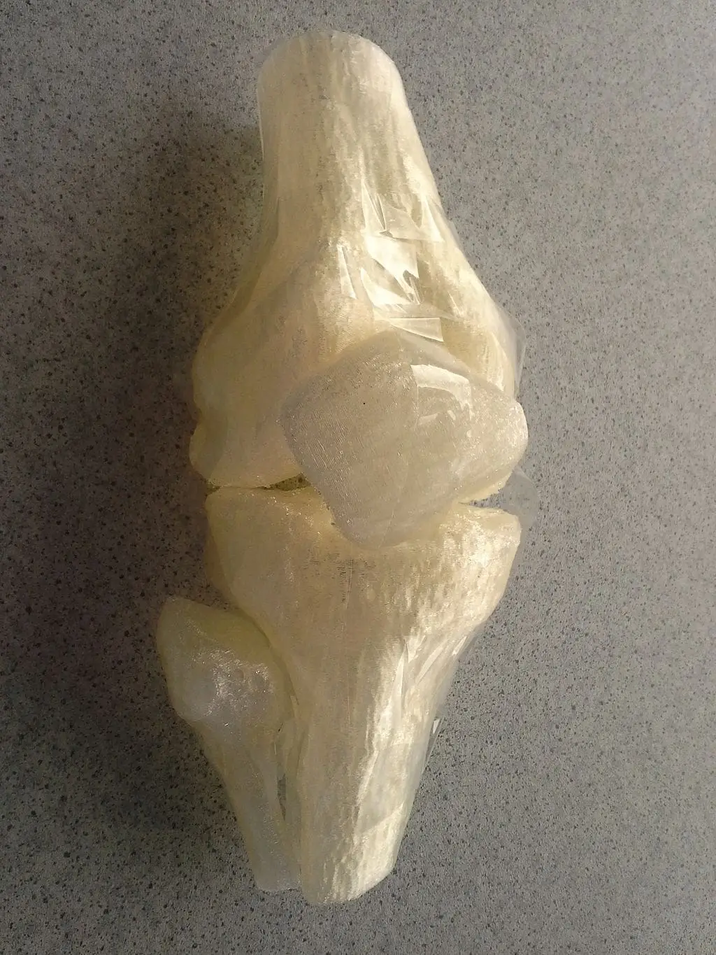 Anteromedialization Tibial Tubercle Osteotomy Improves Patellar Contact Forces: A Cadaveric Model of Patellofemoral Dysplasia