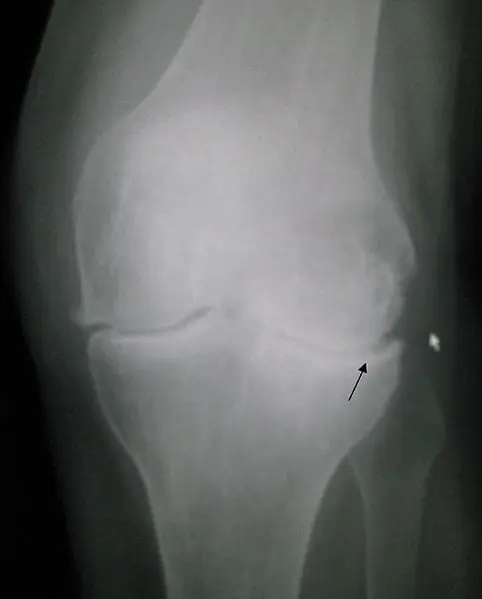 Patellofemoral Joint Loading, Early Osteoarthritis after ACL Reconstruction