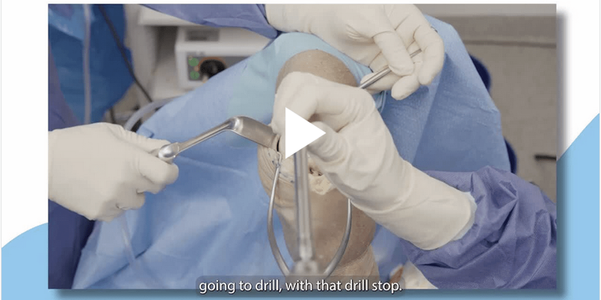 One Step Cartilage Repair: Targeting the Trochlea