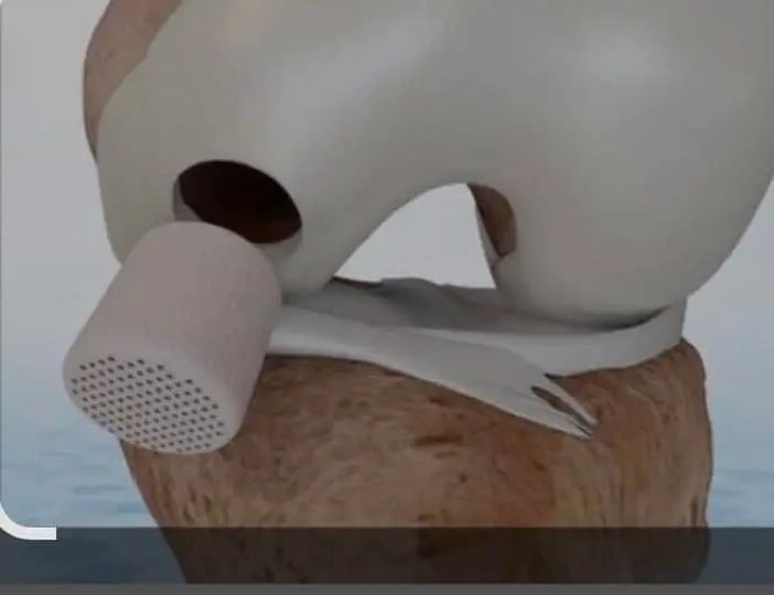 Cartiheal Is Back: New Cartilage Injury Treatment