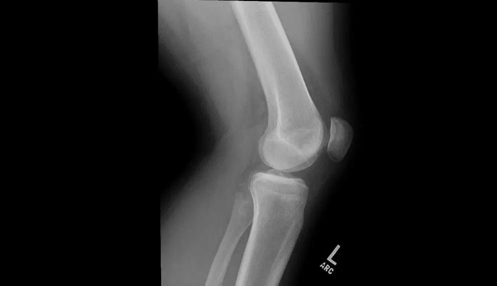 Two Fixation Points Are Better for Medial Patellofemoral Ligament Reconstruction