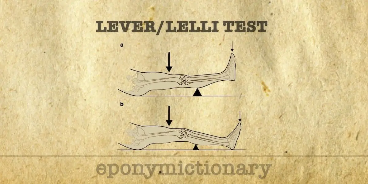 Clinical Reproducibility and Reliability of Lever Sign Test for Acute ACL Tear