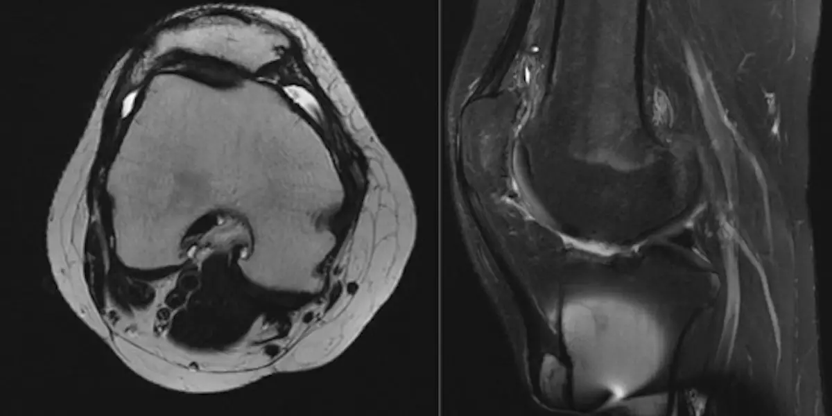 Study Following MACI Cartilage Transplantation Patients