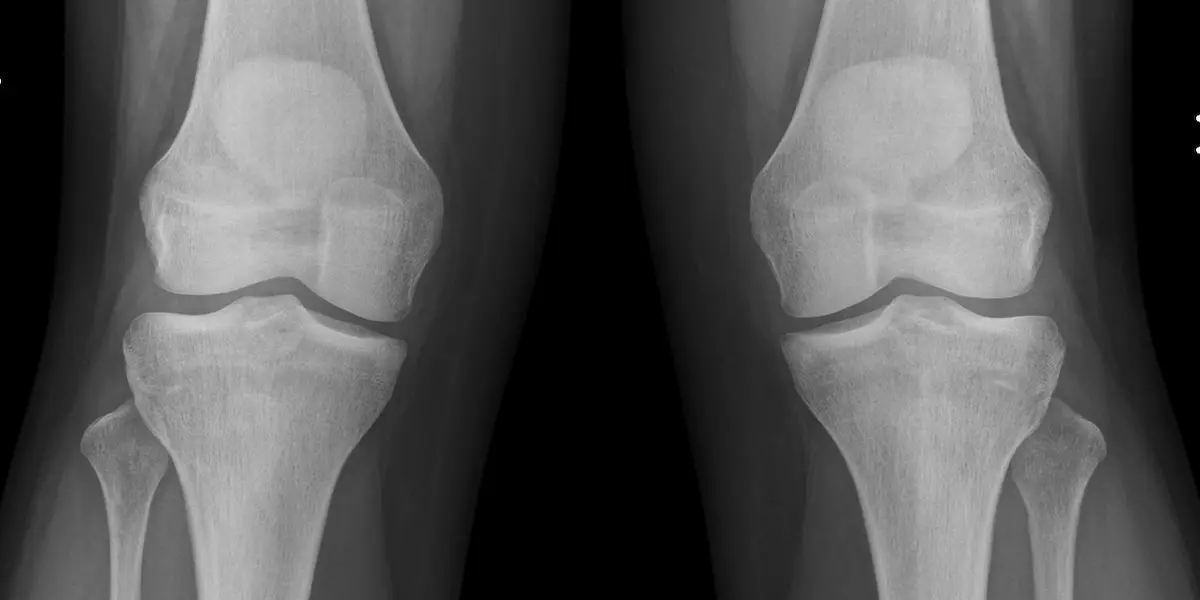 Patellar Attachment Healing Post Surgery