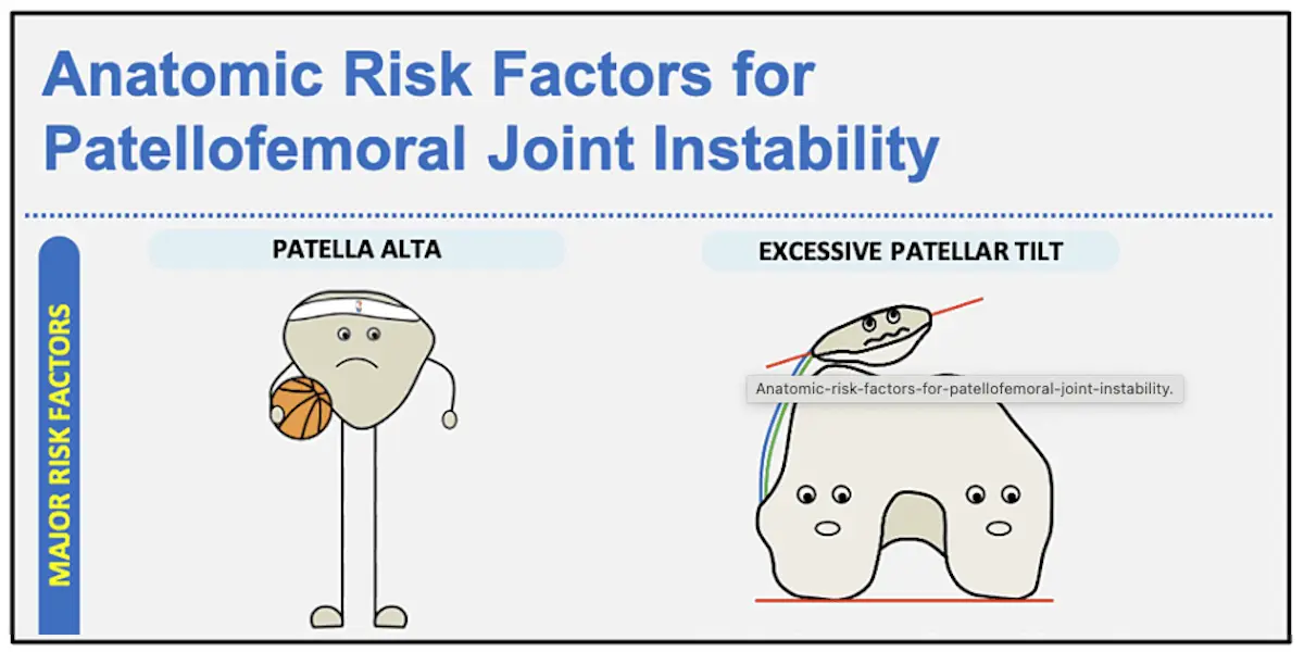 A Useful Patellar Instability Infographic for Everyone
