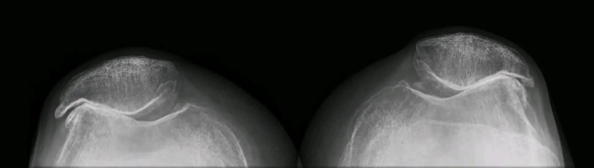 Takeaways from Years of Patellofemoral Arthroplasty Experience