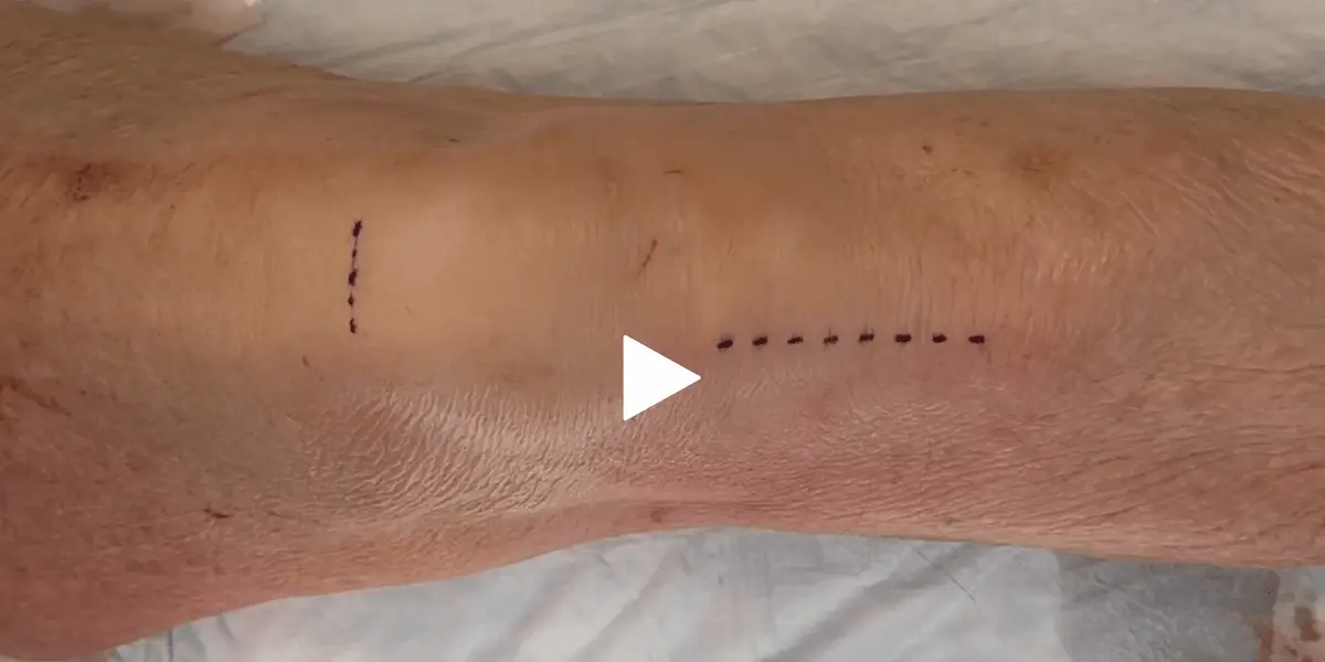 Surgical Technique: Staple Fixation for Combined All-Inside ACWO and ACLR