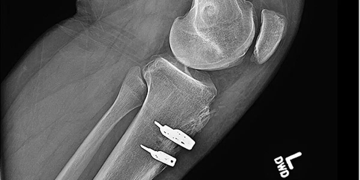 Grand Rounds from HSS: Revision TTO Returns Young Athlete to Sports