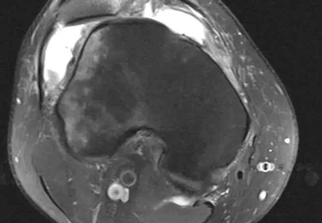 3 Anatomical Factors Linked to Recurring Patellar Dislocation