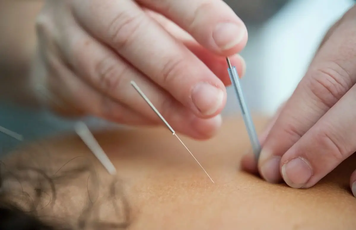 Acupuncture During Surgery May Help Patients With Nosocomephobia