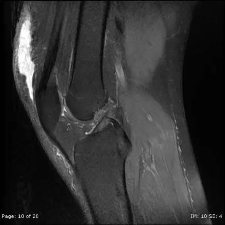 How to Improve Long-term Prognosis for Adolescents with Patellofemoral Pain?