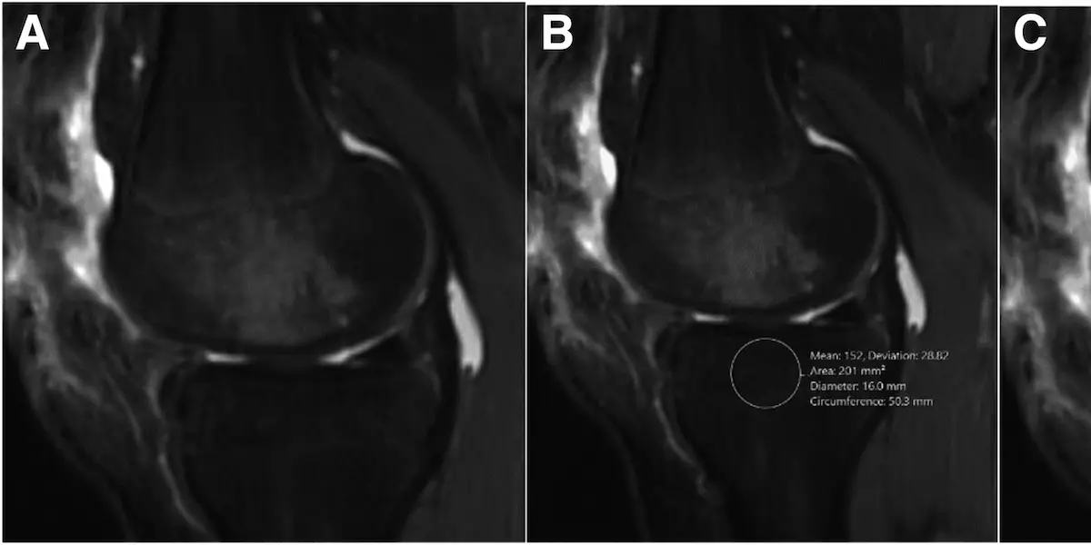 Increased Host Bone Marrow Edema as a Risk Factor for Osteochondral Allograft Failure