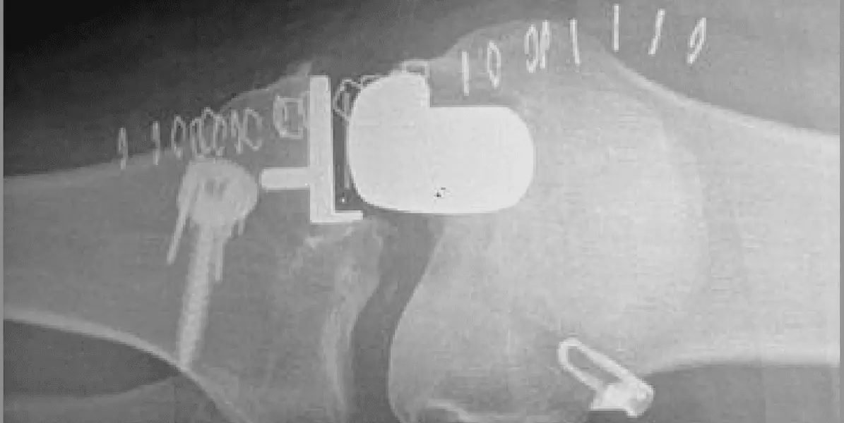 Medial UKA improved pain, function despite patellofemoral joint degeneration