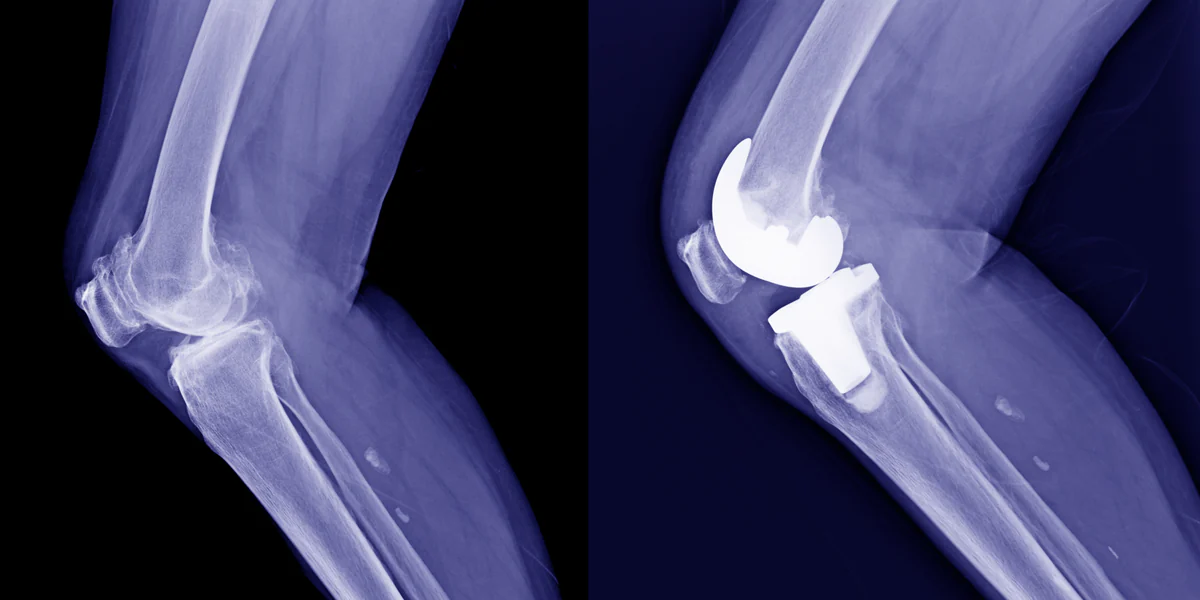 Patellar Resurfacing in Total Knee Replacement: 20-Year Results