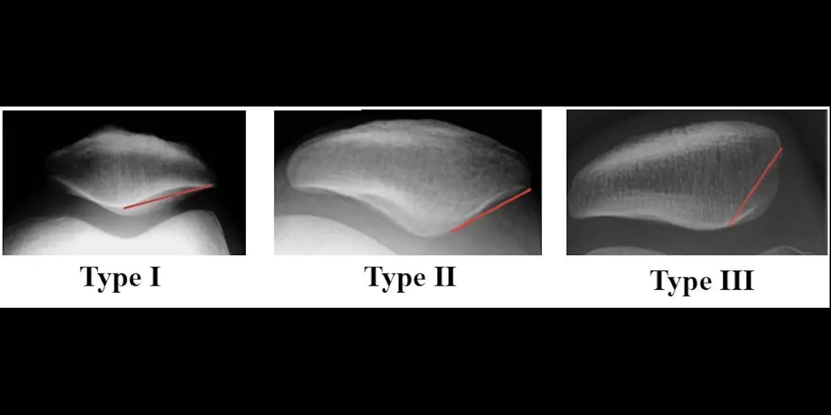 Wiberg Patellar Type Impact on Outcomes and Survival